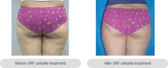 XRF-Fat-Cellulite-Reduction-1img