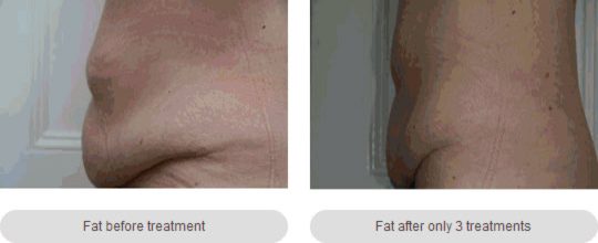 XRF-Fat-Cellulite-Reduction-2img