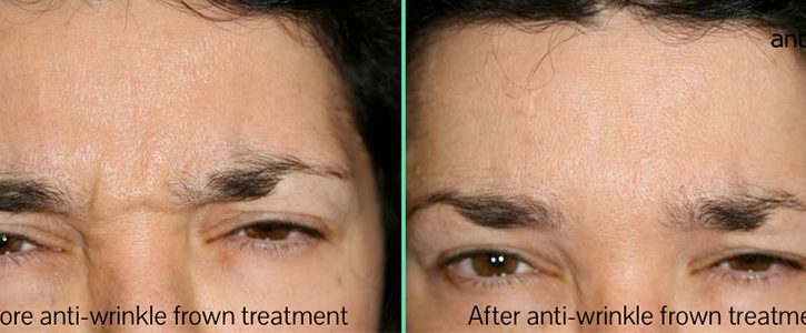 anti-wrinkle-frown-img