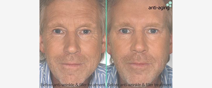 filler-anti-wrinkle-img