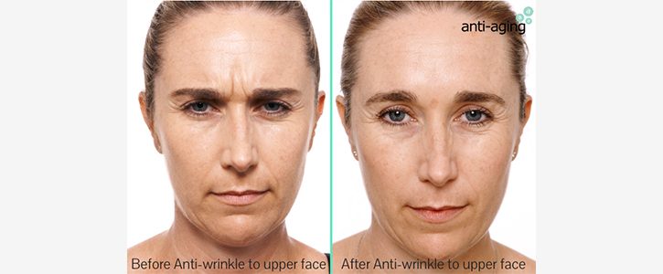wrinkle-upper-face-1img